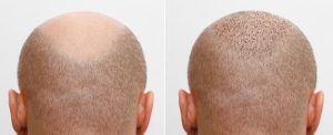 Hair Transplant